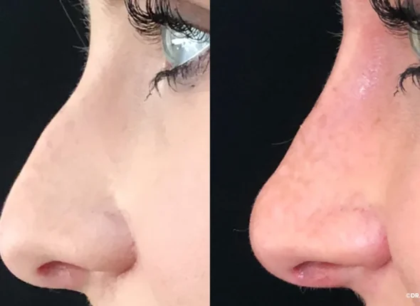 Nonsurgical-rhinoplasty-1296x728-body1