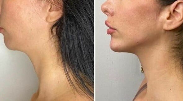 chin-and-jawline-sculpting