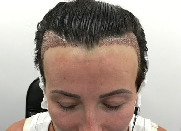 female-hair-transplant-hair-restoration-british-hair-clinic