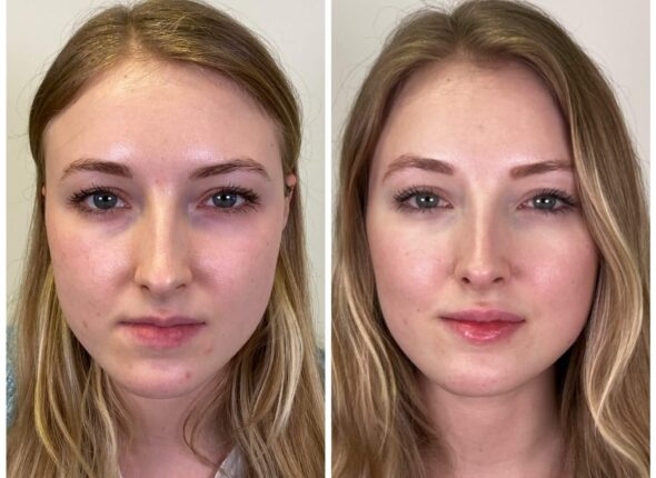 no-filter-clinic-face-balancing-results-3