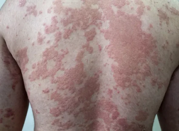 severe-psoriasis-on-back