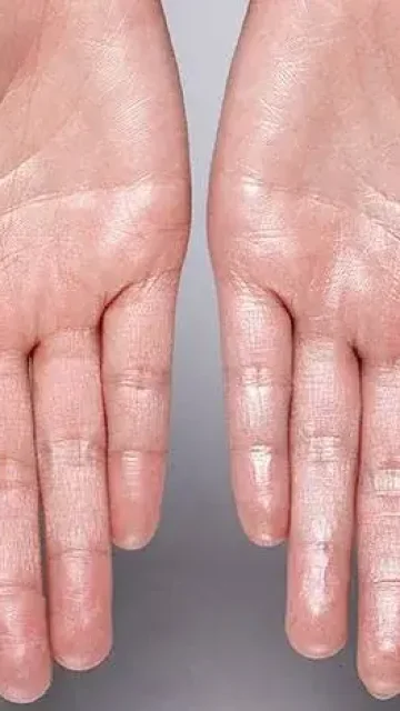 hyperhidrosis hyperhidrosis